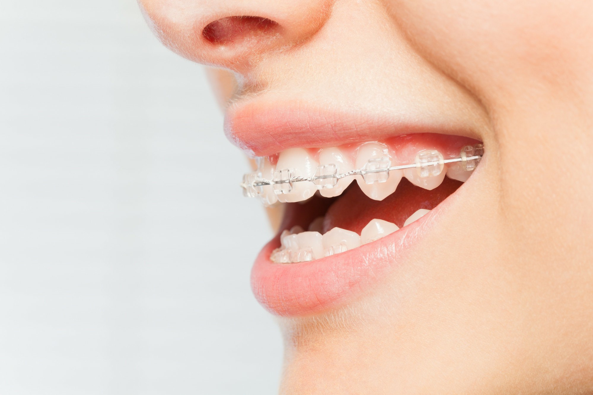 Goodbye Crooked Teeth: A Look at Different Braces Options